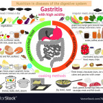 Infographics Proper Nutrition Gastritis Royalty Free Vector