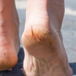 6 Reasons Your Feet Are Peeling even In Summer