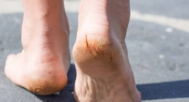 6 Reasons Your Feet Are Peeling even In Summer 