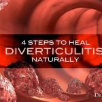 Diverticulitis Is An Inflammatory Condition Characterized