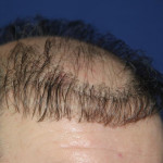 Do Not Have A Hair Transplant Bald Gossip