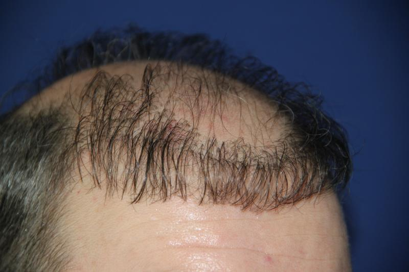 Do Not Have A Hair Transplant Bald Gossip