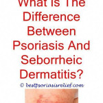Everything You Need To Know About Psoriasis Treat