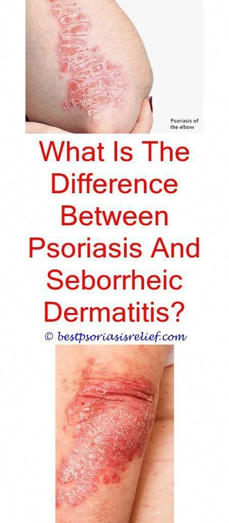Everything You Need To Know About Psoriasis Treat