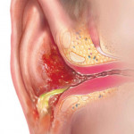 External Otitis Causes Symptoms Diagnosis Treatment