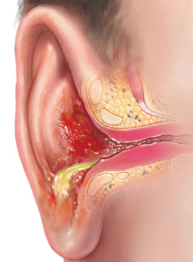 External Otitis Causes Symptoms Diagnosis Treatment