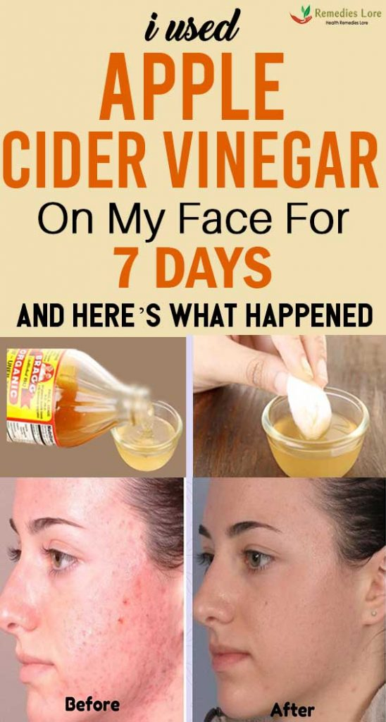 I Used Apple Cider Vinegar On My Face For 7 Days And Here 