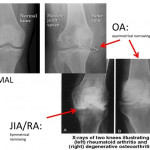 Image Result For Osteoarthritis Vs Rheumatoid Arthritis X
