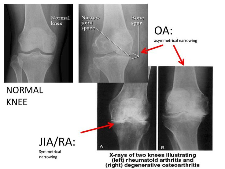 Image Result For Osteoarthritis Vs Rheumatoid Arthritis X 