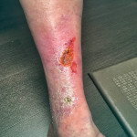 Leg Wounds Sores Atlas Vein Care