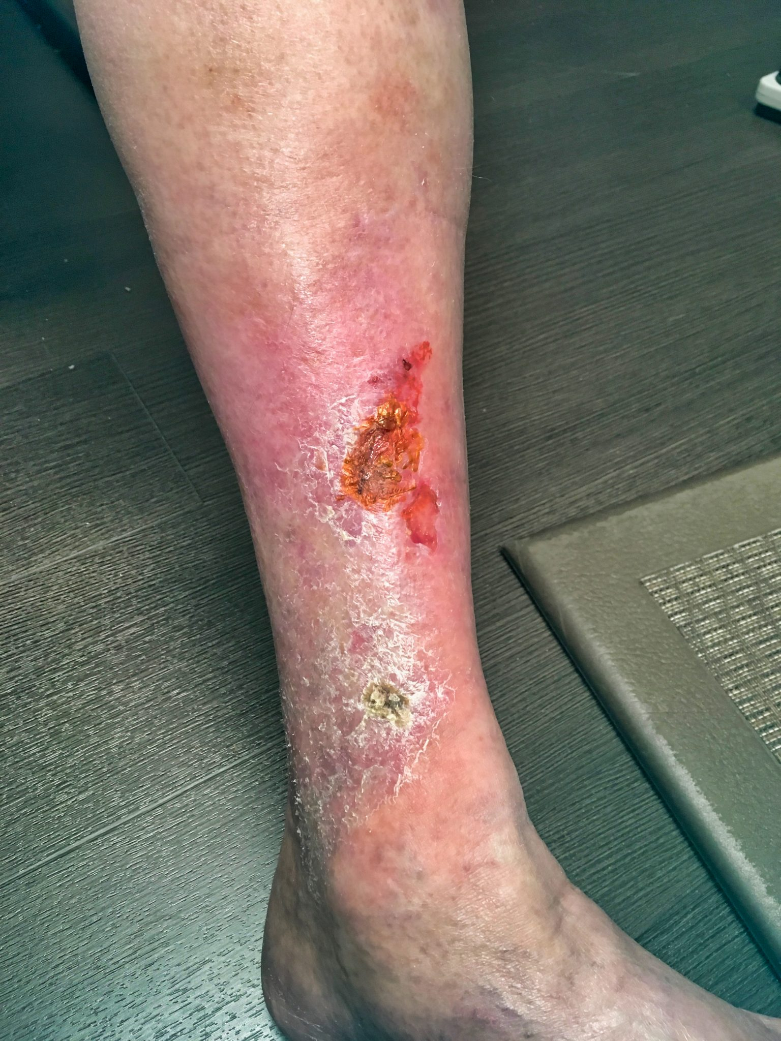 Leg Wounds Sores Atlas Vein Care