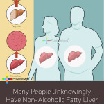 Many People Unknowingly Have Non Alcoholic Fatty Liver
