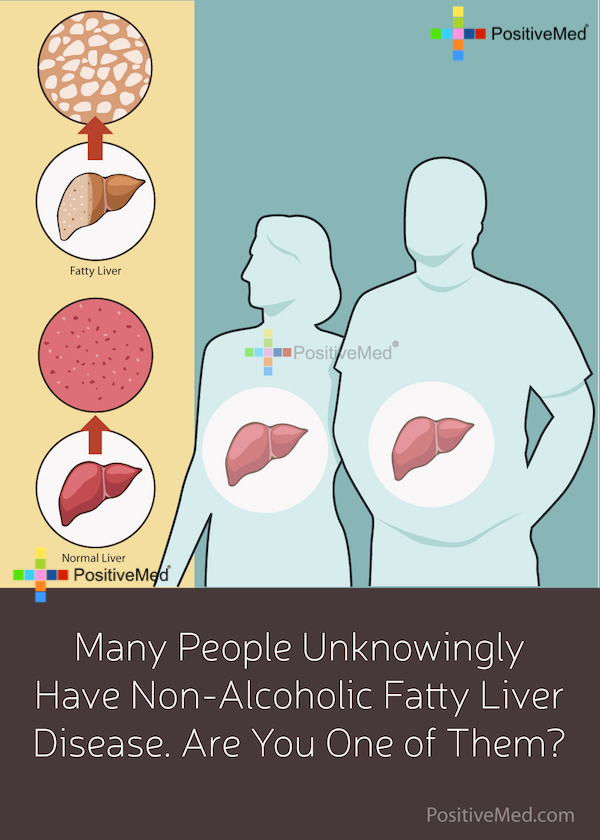 Many People Unknowingly Have Non Alcoholic Fatty Liver 