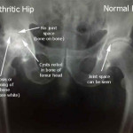Top 5 Ways To Avoid A Hip Replacement