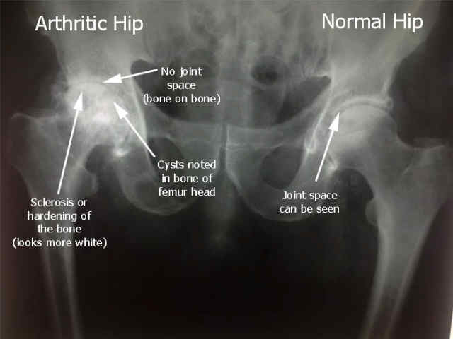 Top 5 Ways To Avoid A Hip Replacement