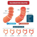 When Are Liquid Diets Used In IBD Liquid Diet For Crohn