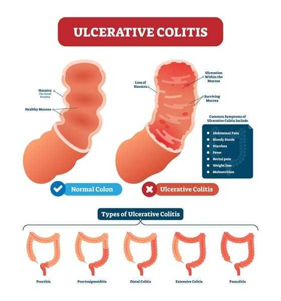 When Are Liquid Diets Used In IBD Liquid Diet For Crohn 