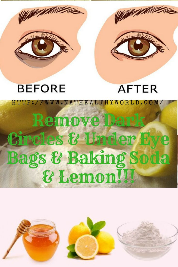 Remove Dark Circles Under Eye Bags Baking Soda Lemon 