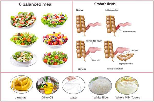 Vegan Diet Ulcerative Colitis Diet Plan