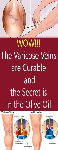 Pin On Varicose Veins